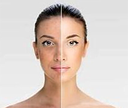 Pigmentation Removal Treatment