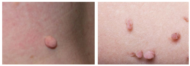 Skin Tag Removal