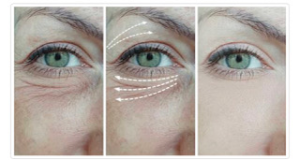 lumi eyes treatment before and after